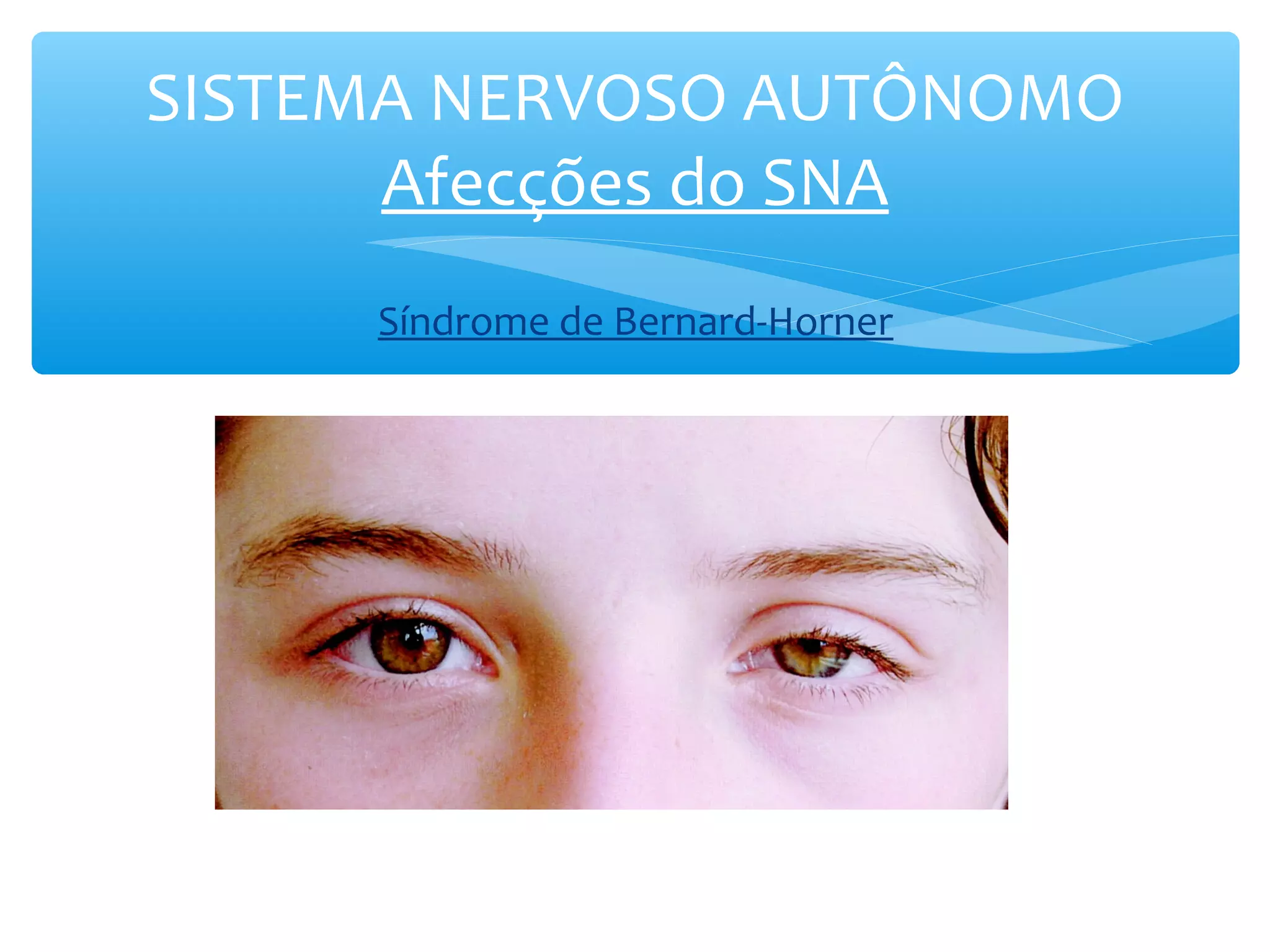 SISTEMA NERVOSO AUTÔNOMO
Afecções do SNA
Síndrome de Bernard-Horner

 