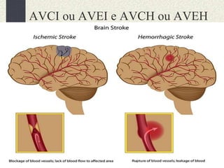 AVCI ou AVEI e AVCH ou AVEH
 