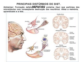 PRINCIPAIS DISTÚRBIOS DO SIST. NERVOSO Alzheimer: Formação defeituosa de uma proteína (tau) que participa dos microtúbulos com conseqüente destruição dos neurônios. Afeta a memória,  aprendizado e a fala. 