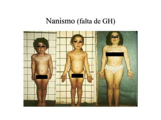 Nanismo  (falta de GH) 