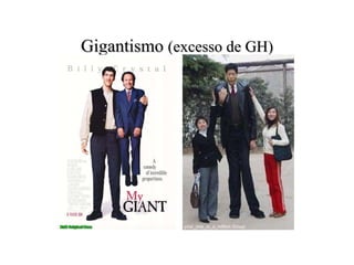 Gigantismo  (excesso de GH) 