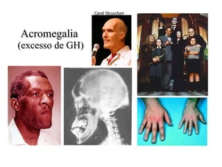Acromegalia  (excesso de GH) Carel Struycken   
