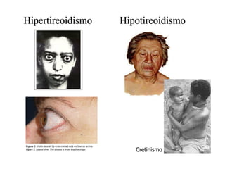 Hipertireoidismo  Hipotireoidismo Cretinismo 