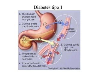Diabetes tipo 1 