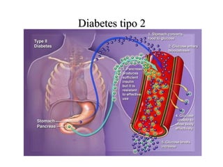 Diabetes tipo 2 