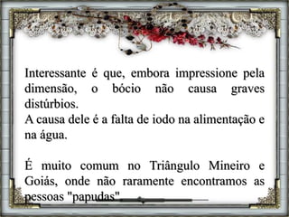 Interessante é que, embora impressione pela
dimensão, o bócio não causa graves
distúrbios.
A causa dele é a falta de iodo na alimentação e
na água.
É muito comum no Triângulo Mineiro e
Goiás, onde não raramente encontramos as
pessoas "papudas".
 