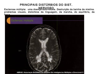 PRINCIPAIS DISTÚRBIOS DO SIST.
NERVOSO
múltipla: uma doença auto-imune. Destruição da

Esclerose
bainha de mielina.
problemas visuais, distúrbios da linguagem, da marcha, do equilíbrio, da
força.

 