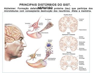 PRINCIPAIS DISTÚRBIOS DO SIST.
NERVOSO
Formação defeituosa de uma proteína (tau)

Alzheimer:
que participa dos
microtúbulos com conseqüente destruição dos neurônios. Afeta a memória,
aprendizado e a fala.

 