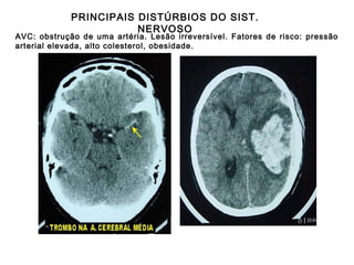 PRINCIPAIS DISTÚRBIOS DO SIST.
NERVOSO

AVC: obstrução de uma artéria. Lesão irreversível. Fatores de risco: pressão
arterial elevada, alto colesterol, obesidade.

 