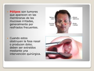  Pólipos son tumores
que aparecen en las
membranas de las
mucosas irritadas,
generalmente por
resfriados frecuentes.
 Cuando estos
obstruyen la fosa nasal
o producen dolor,
deben ser extraídos
mediante una
intervención quirúrgica.
 