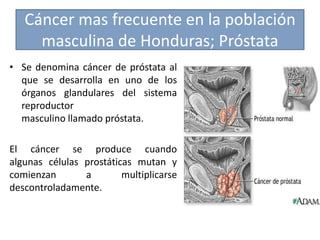 Cáncer mas frecuente en la población
masculina de Honduras; Próstata
• Se denomina cáncer de próstata al
que se desarrolla en uno de los
órganos glandulares del sistema
reproductor
masculino llamado próstata.
El cáncer se produce cuando
algunas células prostáticas mutan y
comienzan a multiplicarse
descontroladamente.
 