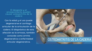 Con la edad y el uso puede
degenerarse el cartílago
articular de la articulación de la
cadera. El diagnóstico de esta
afección es la artrosis, también
conocida como artritis
degenerativa o enfermedad
articular degenerativa.
El desgaste y el
envejecimiento pueden
causar osteoartritis de la
cadera
 