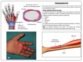 TENOSINOVITIS
Es la inflamación del revestimiento de la vaina que rodea al tendón, el cordón que
une el músculo con el hueso.
Causas, incidencia y factores de riesgo
La membrana sinovial es un revestimiento de la vaina protectora que cubre los
tendones. La tenosinovitis se refiere a la inflamación de dicha vaina. La causa de la
inflamación puede ser desconocida o puede ser producto de:
• Infección
• Lesión
• Sobrecarga
• Tensión
Las muñecas, las manos y los pies resultan frecuentemente afectados; sin embargo,
la afección puede presentarse con cualquier vaina tendinosa.
Nota: una cortadura infectada en las manos o las muñecas que ocasione
tenosinovitis puede ser una situación de emergencia que requiera cirugía.
 