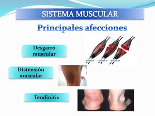 Desgarro 
muscular 
Distensión 
muscular 
Tendinitis 
 