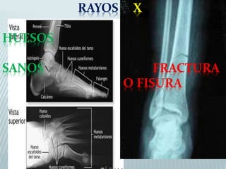 RAYOS X 
HUESOS 
SANOS FRACTURA 
O FISURA 
 