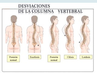 DESVIACIONES 
DE LA COLUMNA VERTEBRAL 
 