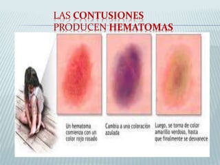 LAS CONTUSIONES 
PRODUCEN HEMATOMAS 
 