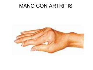 MANO CON ARTRITIS  