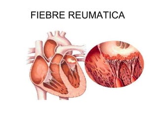 FIEBRE REUMATICA  