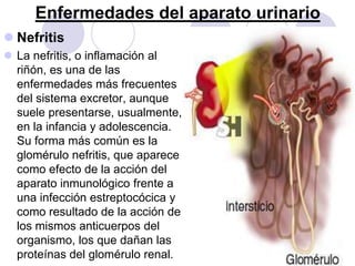 Enfermedades del aparato urinario
 Nefritis
 La nefritis, o inflamación al
  riñón, es una de las
  enfermedades más frecuentes
  del sistema excretor, aunque
  suele presentarse, usualmente,
  en la infancia y adolescencia.
  Su forma más común es la
  glomérulo nefritis, que aparece
  como efecto de la acción del
  aparato inmunológico frente a
  una infección estreptocócica y
  como resultado de la acción de
  los mismos anticuerpos del
  organismo, los que dañan las
  proteínas del glomérulo renal.
 