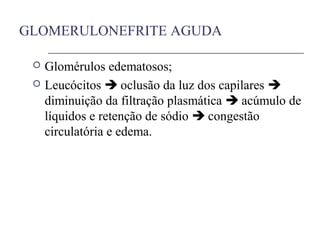 GLOMERULONEFRITE AGUDA
 Glomérulos edematosos;
 Leucócitos  oclusão da luz dos capilares 
diminuição da filtração plasmática  acúmulo de
líquidos e retenção de sódio  congestão
circulatória e edema.
 