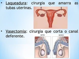 • Laqueadura: cirurgia que amarra as
tubas uterinas.
• Vasectomia: cirurgia que corta o canal
deferente.
 