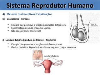 4) Métodos contraceptivos (Esterilização)
h) Vasectomia - Homens
 Cirurgia que promove a secção dos ductos deferentes.
 Espermatozóides não chegam a uretra.
 Não causa impotência sexual.
i) Ligadura tubária (ligadura de tromas) - Mulheres
 Cirurgia que promove a secção das tubas uterinas.
 Óvulos (ovócitos II) produzidos não conseguem chegar ao útero.
Sistema Reprodutor HumanoSistema Reprodutor Humano
Ligadura tubária
 