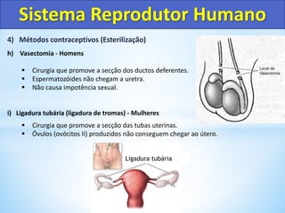 4) Métodos contraceptivos (Esterilização)
h) Vasectomia - Homens
 Cirurgia que promove a secção dos ductos deferentes.
 Espermatozóides não chegam a uretra.
 Não causa impotência sexual.
i) Ligadura tubária (ligadura de tromas) - Mulheres
 Cirurgia que promove a secção das tubas uterinas.
 Óvulos (ovócitos II) produzidos não conseguem chegar ao útero.
Sistema Reprodutor Humano
Ligadura tubária
 