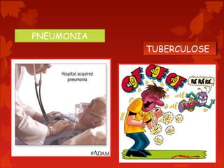 PNEUMONIA
TUBERCULOSE
TUBERCULOSE

 
