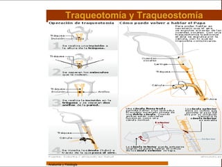 Sistema Respiratorio

                             Traqueotomía y Traqueostomía

     Sistema


Fosas Nasales


     Faringe


     Laringe


     Tráquea


   Bronquios


 Bronquiolos


   Pulmones


    Fisiología




                 Anatomía y Fisiología                              37
 