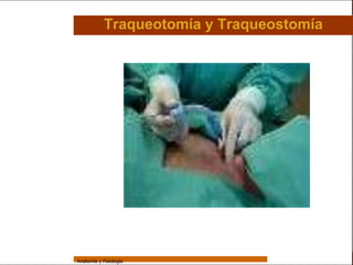 Sistema Respiratorio

                             Traqueotomía y Traqueostomía

     Sistema


Fosas Nasales


     Faringe


     Laringe


     Tráquea


   Bronquios


 Bronquiolos


   Pulmones


    Fisiología




                 Anatomía y Fisiología                              38
 