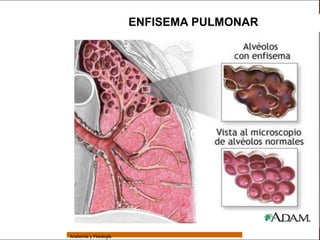 Sistema Respiratorio

                                         ENFISEMA PULMONAR


     Sistema


Fosas Nasales


     Faringe


     Laringe


     Tráquea


   Bronquios


 Bronquiolos


   Pulmones


    Fisiología




                 Anatomía y Fisiología                                   64
 
