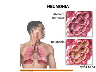 Sistema Respiratorio

                                         NEUMONIA

     Sistema


Fosas Nasales


     Faringe


     Laringe


     Tráquea


   Bronquios


 Bronquiolos


   Pulmones


    Fisiología




                 Anatomía y Fisiología                              66
 