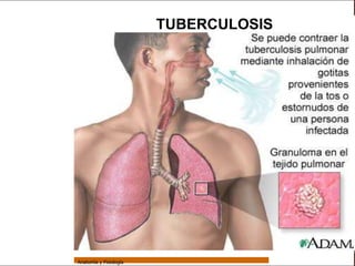 Sistema Respiratorio

                                         TUBERCULOSIS

     Sistema


Fosas Nasales


     Faringe


     Laringe


     Tráquea


   Bronquios


 Bronquiolos


   Pulmones


    Fisiología




                 Anatomía y Fisiología                                  68
 