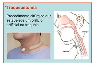 *Traqueostomia
Procedimento cirúrgico que
estabelece um orifício
artificial na traquéia.
 