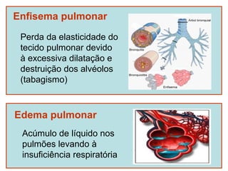 Enfisema pulmonar

 Perda da elasticidade do
 tecido pulmonar devido
 à excessiva dilatação e
 destruição dos alvéolos
 (tabagismo)



Edema pulmonar
 Acúmulo de líquido nos
 pulmões levando à
 insuficiência respiratória
 