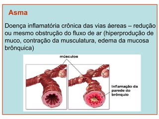 Asma
Doença inflamatória crônica das vias áereas – redução
ou mesmo obstrução do fluxo de ar (hiperprodução de
muco, contração da musculatura, edema da mucosa
brônquica)
 