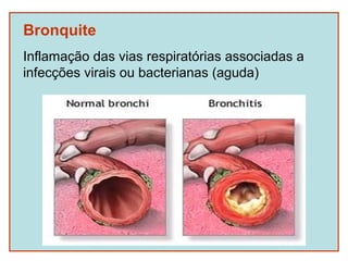 Bronquite
Inflamação das vias respiratórias associadas a
infecções virais ou bacterianas (aguda)
 