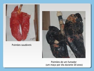 Pulmões saudáveis
Pulmões de um fumador
(um maço por dia durante 20 anos)
 