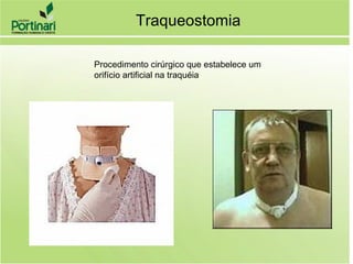 Traqueostomia
Procedimento cirúrgico que estabelece um
orifício artificial na traquéia
 