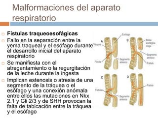 Malformaciones del aparato
respiratorio
 Fístulas traqueoesofágicas
 Fallo en la separación entre la
yema traqueal y el esófago durante
el desarrollo inicial del aparato
respiratorio
 Se manifiesta con el
atragantamiento o la regurgitación
de la leche durante la ingesta
 Implican estenosis o atresia de una
segmento de la tráquea o el
esófago y una conexión anómala
entre ellos las mutaciones en Nkx
2.1 y Gli 2/3 y de SHH provocan la
falta de tabicación entre la tráquea
y el esófago
 