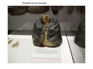 Pulmão de um fumante
 