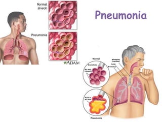 Pneumonia
 