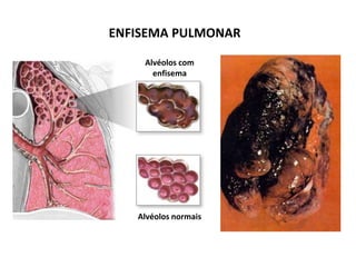 ENFISEMA PULMONAR
Alvéolos com
enfisema
Alvéolos normais
 