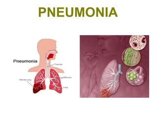 PNEUMONIA
 