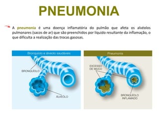 A pneumonia é uma doença inflamatória do pulmão que afeta os alvéolos
pulmonares (sacos de ar) que são preenchidos por líquido resultante da inflamação, o
que dificulta a realização das trocas gasosas.
PNEUMONIA
 