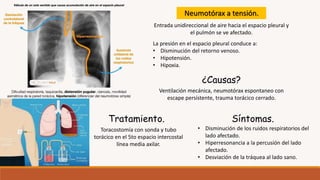 ¿Causas?
Ventilación mecánica, neumotórax espontaneo con
escape persistente, trauma torácico cerrado.
Neumotórax a tensión.
Entrada unidireccional de aire hacia el espacio pleural y
el pulmón se ve afectado.
La presión en el espacio pleural conduce a:
• Disminución del retorno venoso.
• Hipotensión.
• Hipoxia.
• Disminución de los ruidos respiratorios del
lado afectado.
• Hiperresonancia a la percusión del lado
afectado.
• Desviación de la tráquea al lado sano.
Síntomas.
Toracostomía con sonda y tubo
torácico en el 5to espacio intercostal
línea media axilar.
Tratamiento.
 