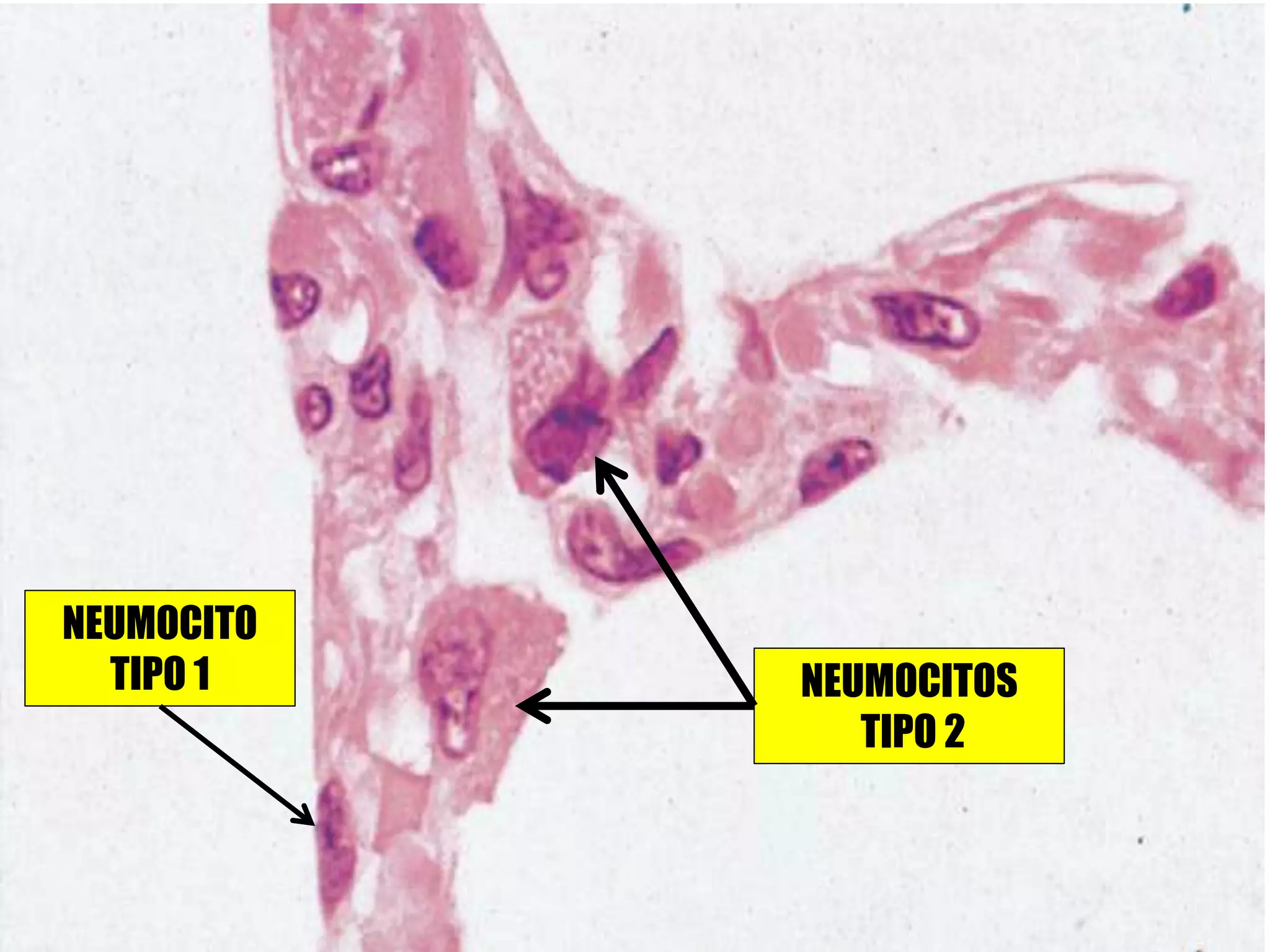 NEUMOCITOS
TIPO 2
NEUMOCITO
TIPO 1
 