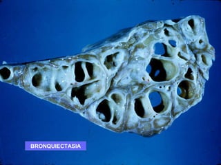 BRONQUIECTASIA 