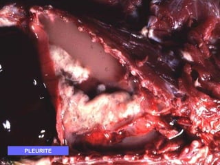 PLEURITE 